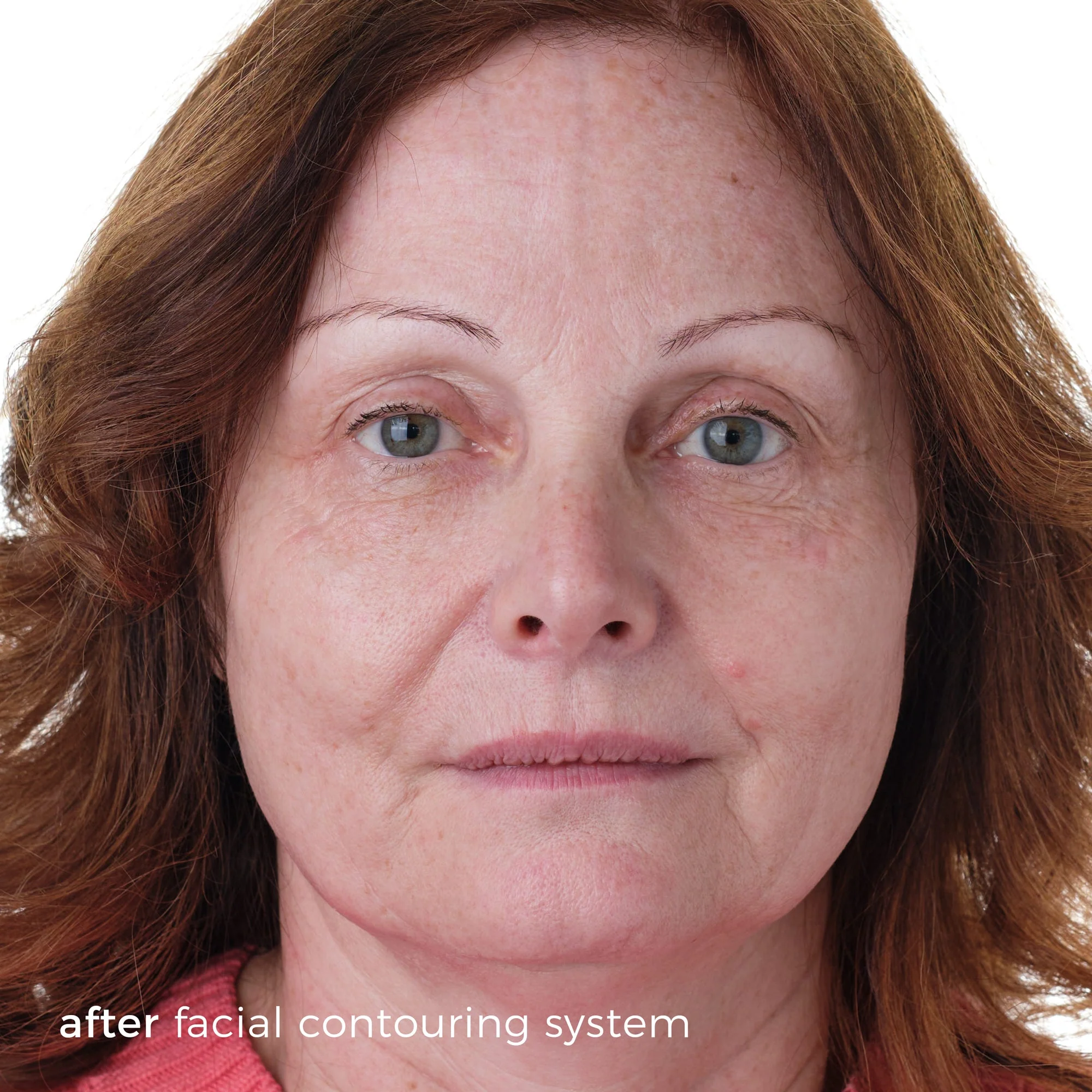 Skinbunny Facial Contouring System - Image 5